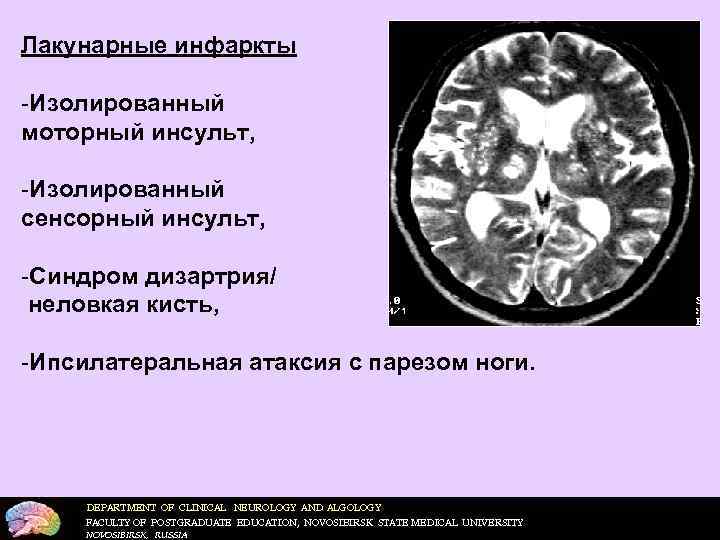     Мозговой кровоток (норма):  - 50 -55 мл в минуту