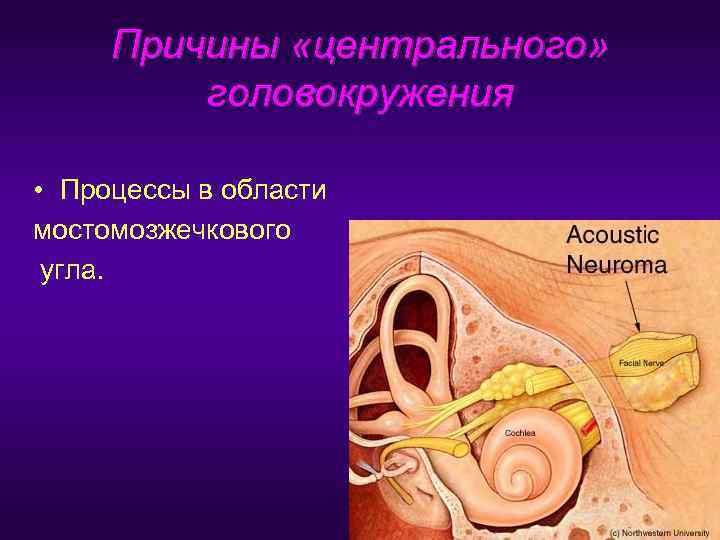  Причины «центрального»  головокружения  • Процессы в области мостомозжечкового угла. 