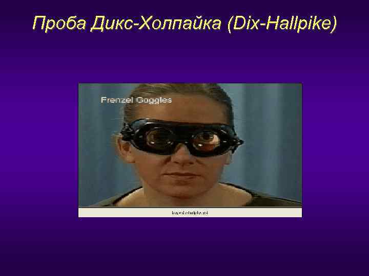 Проба Дикс-Холпайка (Dix-Hallpike) 