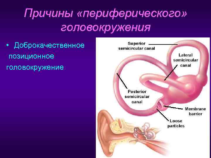   Причины «периферического»  головокружения • Доброкачественное позиционное головокружение 