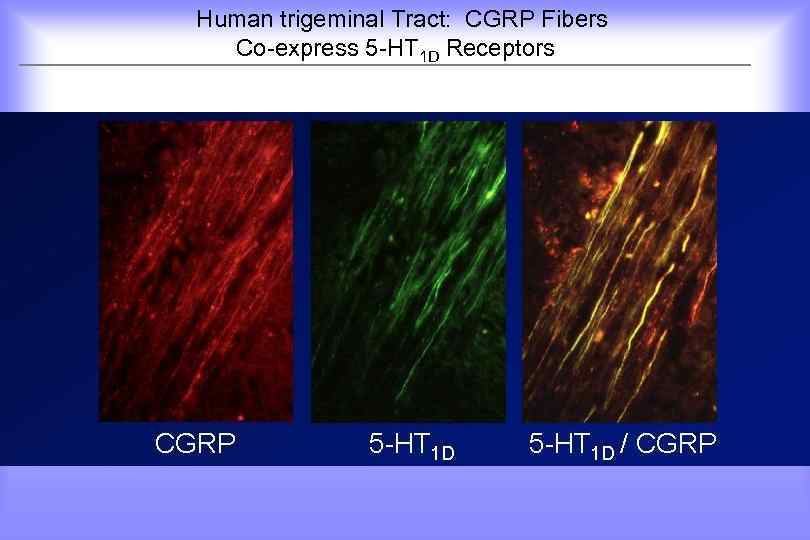 Human trigeminal Tract: CGRP Fibers Co-express 5 -HT 1 D Receptors 