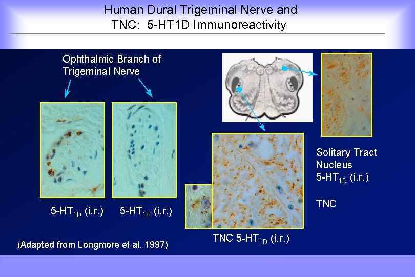 Human Dural Trigeminal Nerve and TNC: 5 -HT 1 D Immunoreactivity 