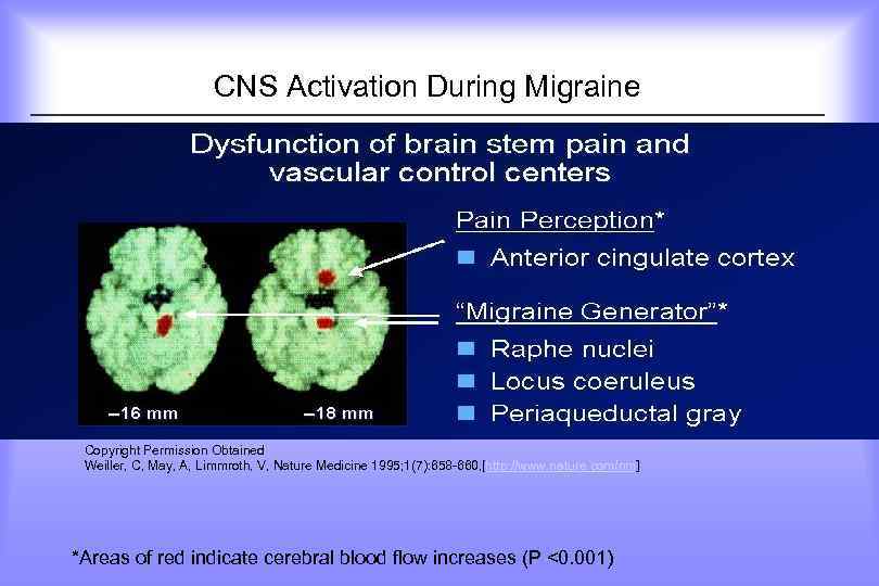  CNS Activation During Migraine Copyright Permission Obtained Weiller, C, May, A, Limmroth, V,