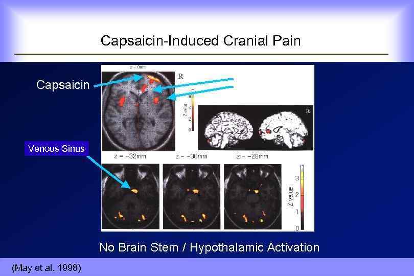  Capsaicin-Induced Cranial Pain Venous Sinus (May et al. 1998) 