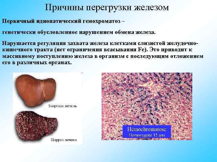  Причины перегрузки железом Первичный идиопатический гемохроматоз – генетически обусловленное нарушением обмена железа. Нарушается