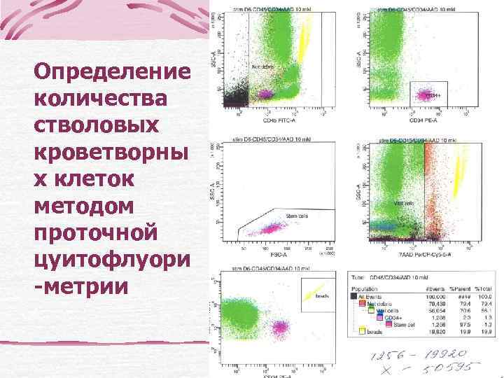   Иммунофенотип опухолевых клеток:  CD 19 +CD 5+ CD 20+CD 23 -CD