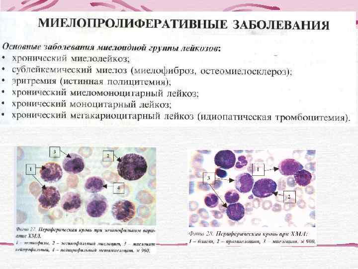    CD 19  CD 10  CD 23  CD 5