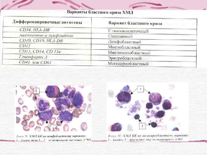 ПАРАПРОТЕИНЕМИЯ    ИММУНОФИКСАЦИ      Я   BECKMAN