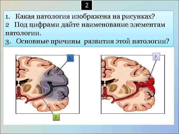  2 1. Какая патология изображена на рисунках? 2 Под цифрами дайте наименование элементам