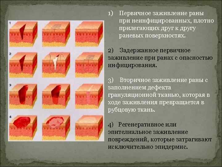 1) Первичное заживление раны при неинфицированных, плотно прилегающих друг к другу раневых поверхностях. 2)