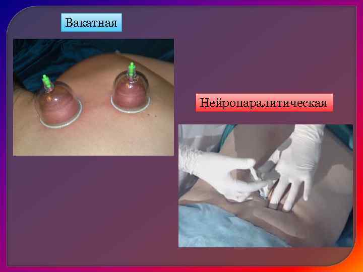    Венозная гиперемия Увеличение кровенаполнения участка ткани при  уменьшении количества оттекающей