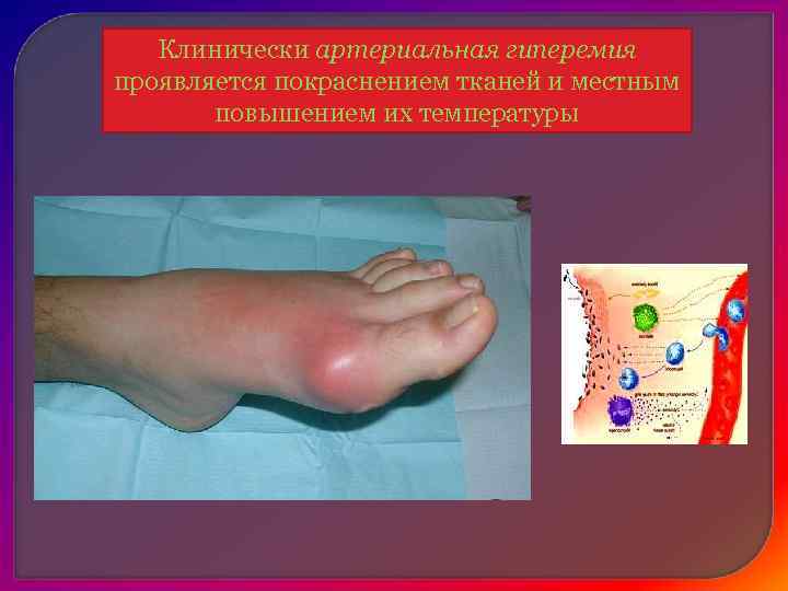 Клинические проявления:  Ø цианоз (синюшный окрас тканей) Ø отек (увеличение органа в объёме).