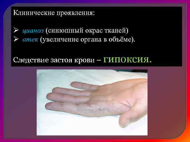  Этиология:  1. полное прекращение притока крови, из-за резкого  нарушения оттока крови;