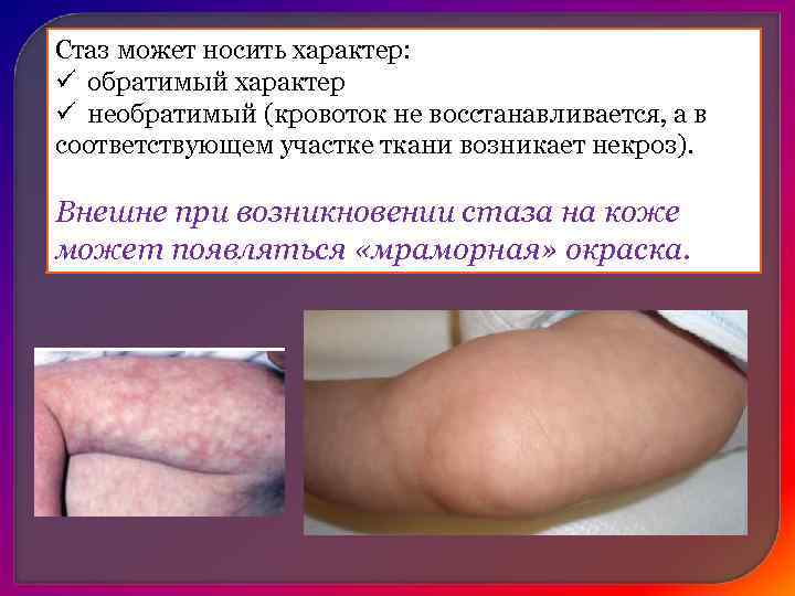     Ишемия уменьшение кровенаполнения какого-либо участка ткани вследствие ослабления или прекращения