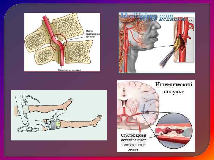 Различают:  • белый инфаркт (ишемический), возникающий в миокарде, почке, головном мозгу. Омертвение по