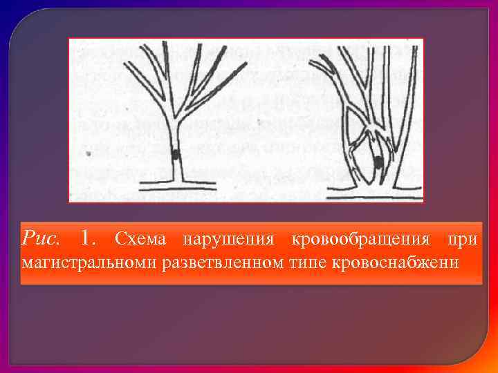 Схема нарушения кровообращения