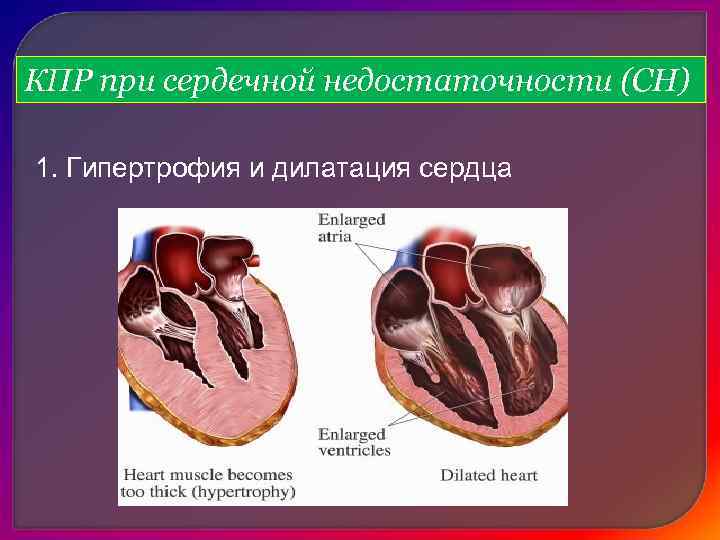 Дилатация камер сердца