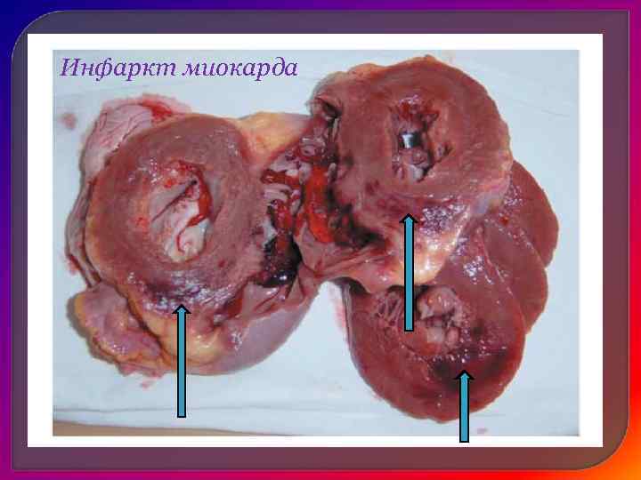   Тромбоз вены = флеботромбоз.  q Если тромбоз сочетается с воспалением стенки