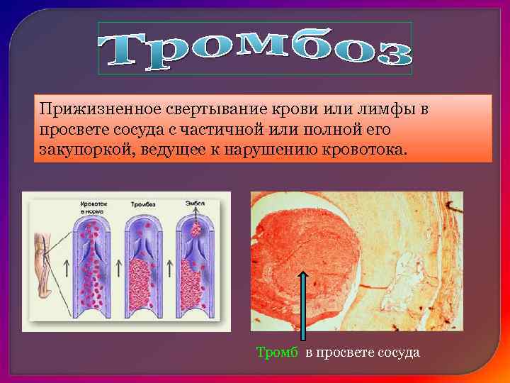 1. Организация тромба 2. Асептический аутолиз – рассасывание тромба (просвет сосуда восстанавливается)= реканализация 3.