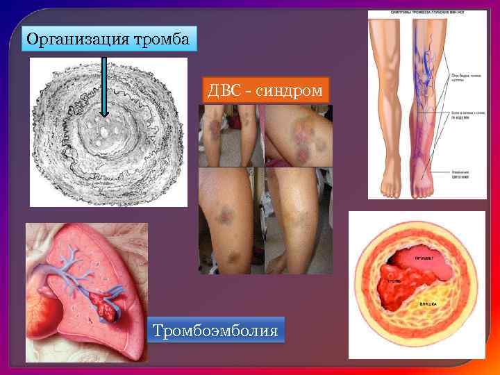Б) тканевая и клеточная эмболия — эмболия участками тканей при травме органа, опухолевыми клетками