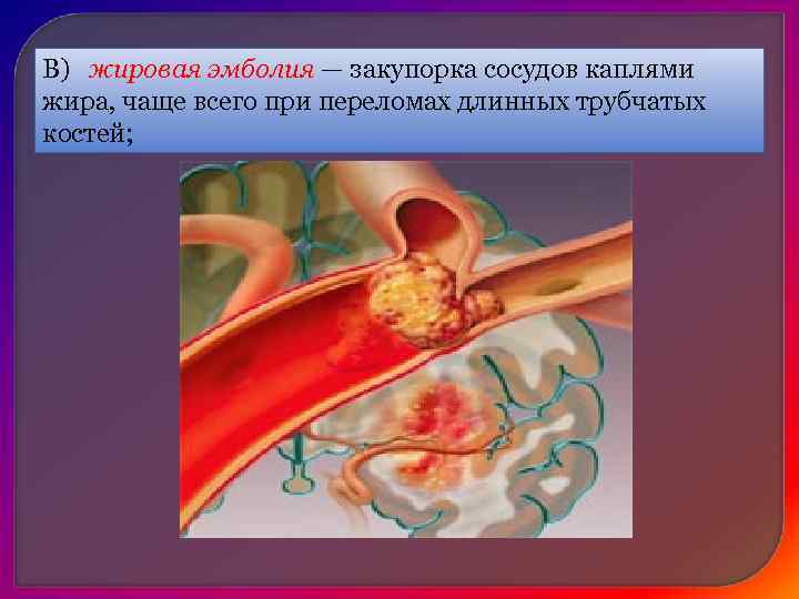 В) бактериальная эмболия — закупорка сосудов конгломератами бактерий при различных заболеваниях (например, при остром