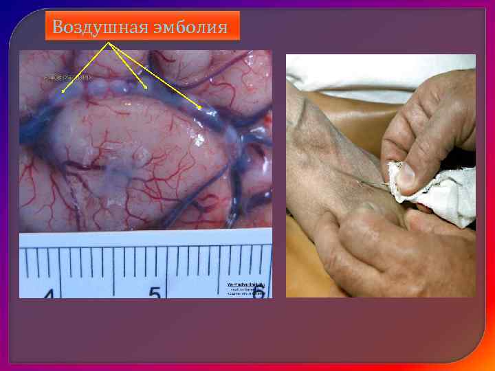   Классификация кровотечений:   По происхождению:  • Травматическое – механическое повреждение