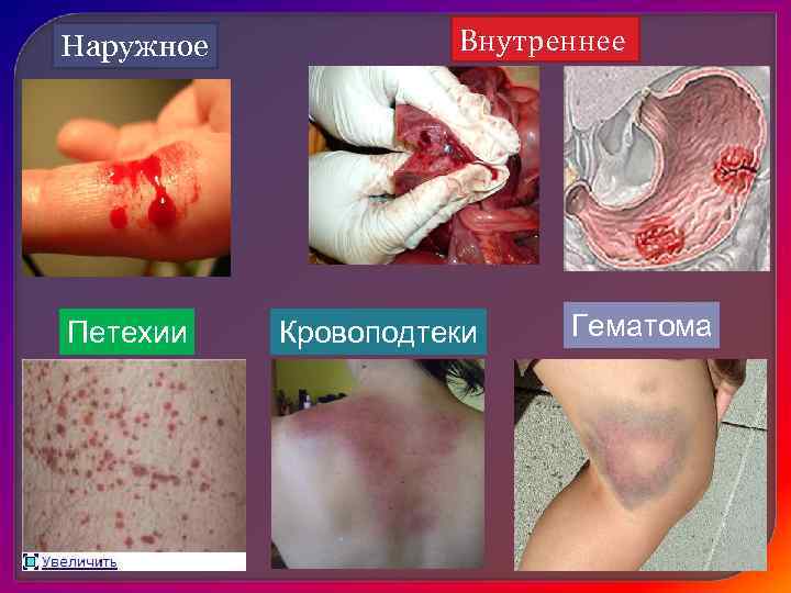   Различают недостаточность: q механическую – при закупорке или сдавлении лимфатических сосудов, 