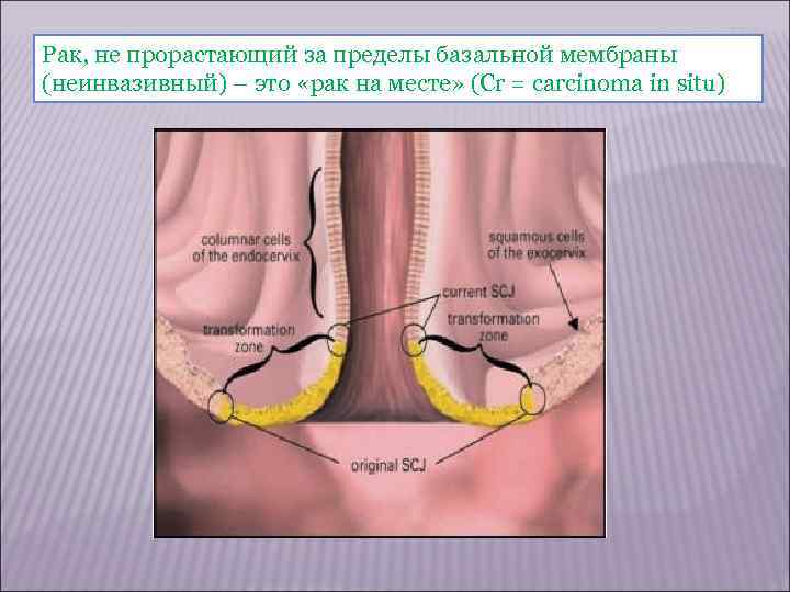   По пути распространения опухолей различают: 1. лимфогенные метастазы (через лимфатическую систему), 2.