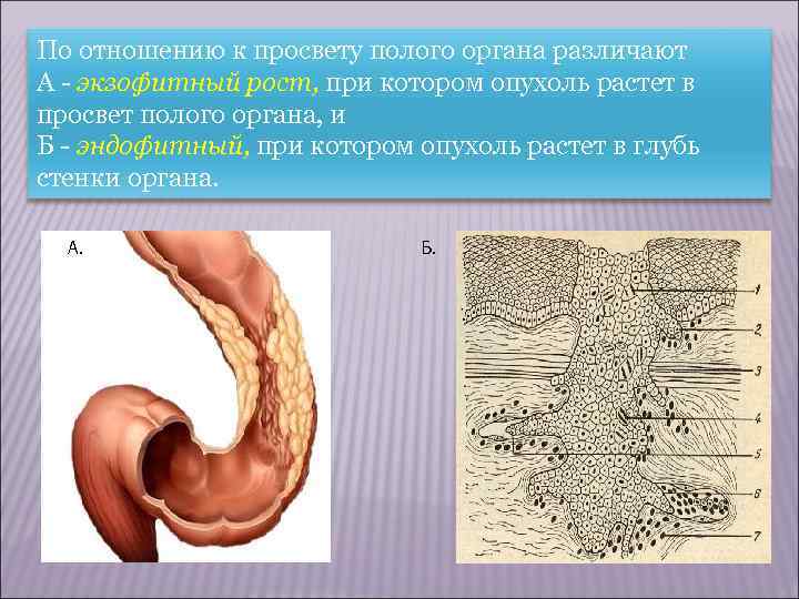   ВОЗДЕЙСТВИЕ ОПУХОЛИ НА ОРГАНИЗМ Воздействие опухоли на организм может быть местным и