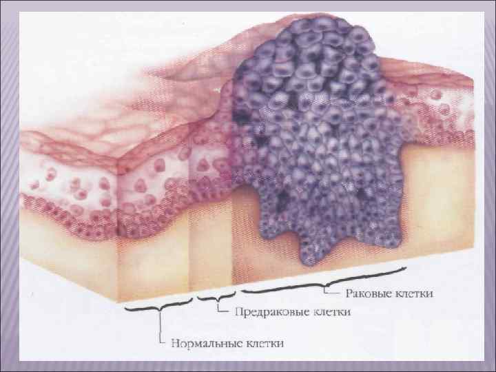 IV. Опухоли меланинообразующей ткани. К доброкачественным опухолям относятся невусы (родимые пятна),  к злокачественным