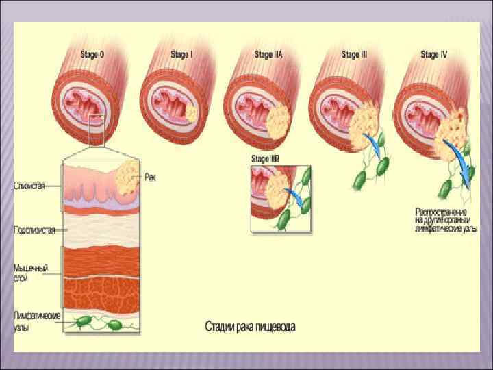 VI. Опухоли из кроветворной и лимфатической ткани подразделяются на: системные заболевания, или лейкозы (они