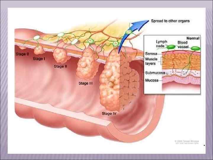 VII. Тератомы возникают при нарушении закладки эмбриональных листков, в связи с чем остатки эмбриональных