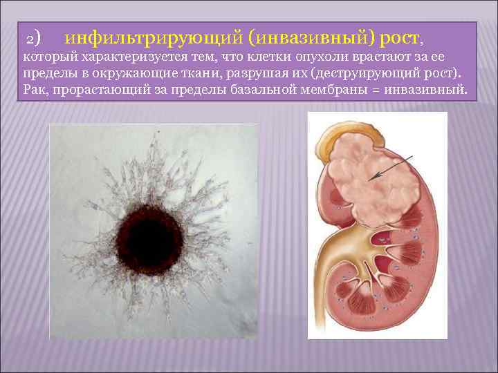   МЕТАСТАЗИРОВАНИЕ Метастазирование заключается в том, что опухолевые клетки, отрываясь от основного узла,