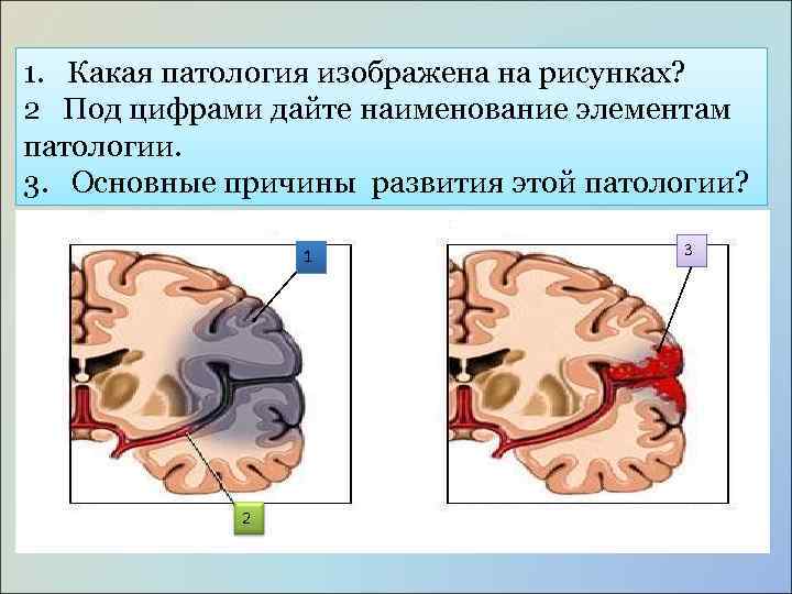 1. Какая патология изображена на рисунках? 2 Под цифрами дайте наименование элементам патологии. 3.