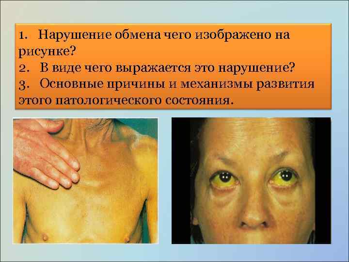 1. Нарушение обмена чего изображено на рисунке? 2. В виде чего выражается это нарушение?