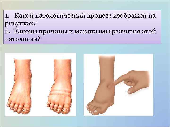 1. Какой патологический процесс изображен на рисунках? 2. Каковы причины и механизмы развития этой