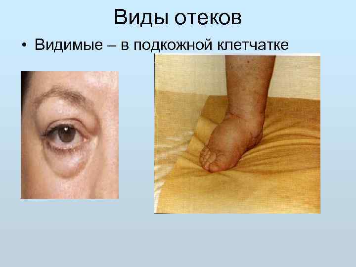  Виды отеков  • Видимые – в подкожной клетчатке 