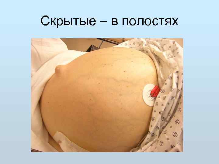 Скрытые – в полостях 