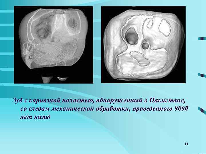 Зуб с кариозной полостью, обнаруженный в Пакистане,  со следам механической обработки, проведенного 9000
