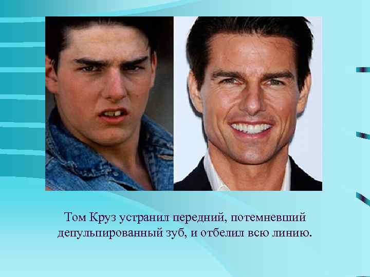  Том Круз устранил передний, потемневший депульпированный зуб, и отбелил всю линию. 