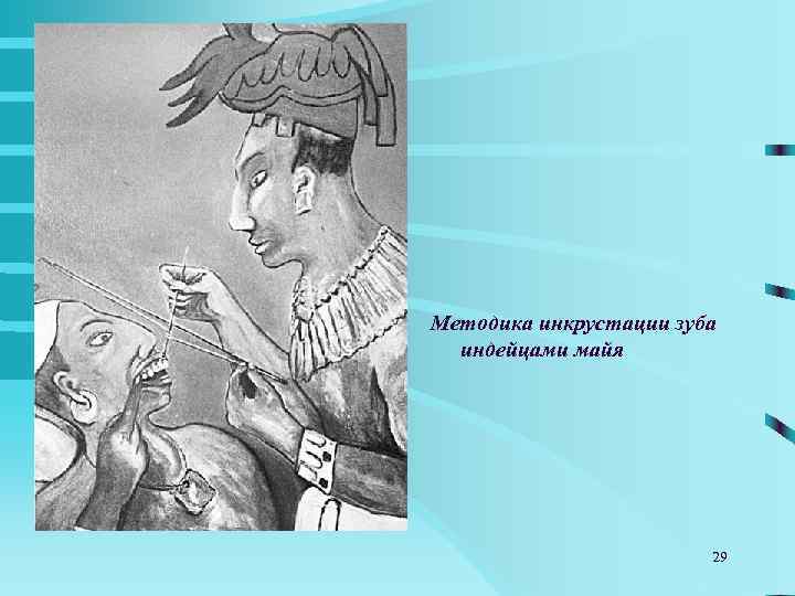 Методика инкрустации зуба  индейцами майя     29 