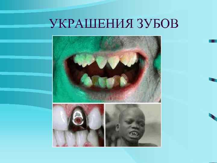 Новый стиль «яэба» ( «двойной зуб» ) - налезающие друг на друга зубы и