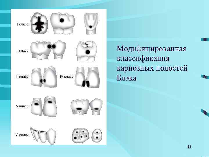 1930 год впервые синтезирован  метилметакрилат (ММА) 1944 год начало использования  пломбировочных материалов