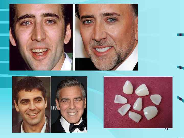 1977 год - фирмой Ivoclar предложены  композиты с микронаполнителем(размер частиц 0, 05 мкм).