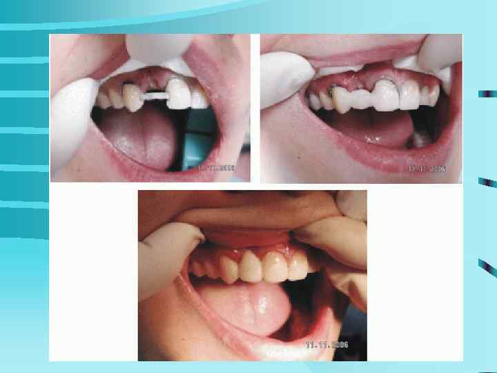 ОТБЕЛИВАНИЕ ЗУБОВ   ПАЦИНТКА 43 г.   ОТБЕЛИВНИЕ   ЗУБОВ С