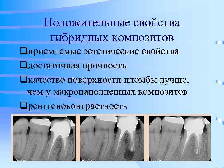  Положительные свойства  гибридных композитов qприемлемые эстетические свойства qдостаточная прочность qкачество поверхности пломбы