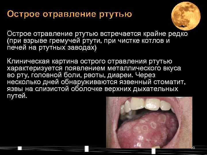 Острое отравление ртутью встречается крайне редко (при взрыве гремучей ртути, при чистке котлов и