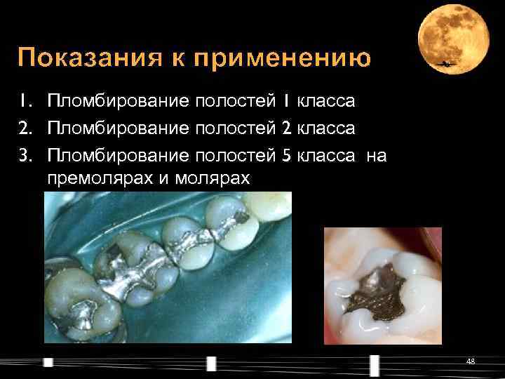 Показания к применению 1. Пломбирование полостей 1 класса 2. Пломбирование полостей 2 класса 3.
