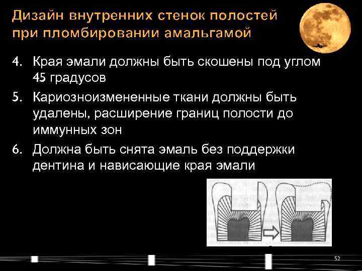 Дизайн внутренних стенок полостей при пломбировании амальгамой 4. Края эмали должны быть скошены под