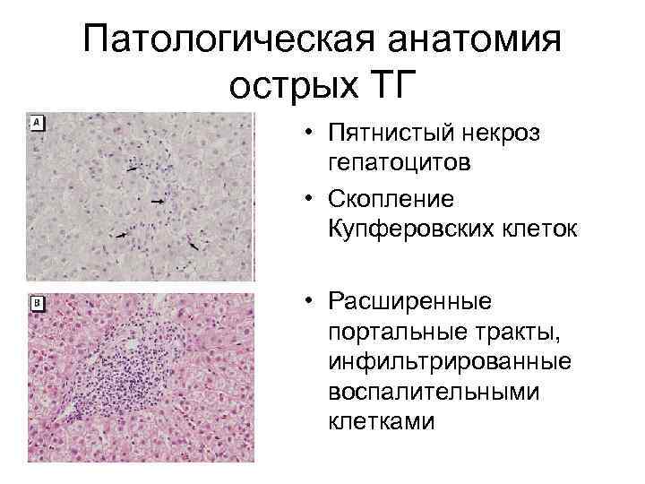 Патологическая анатомия  острых ТГ  • Пятнистый некроз   гепатоцитов  •
